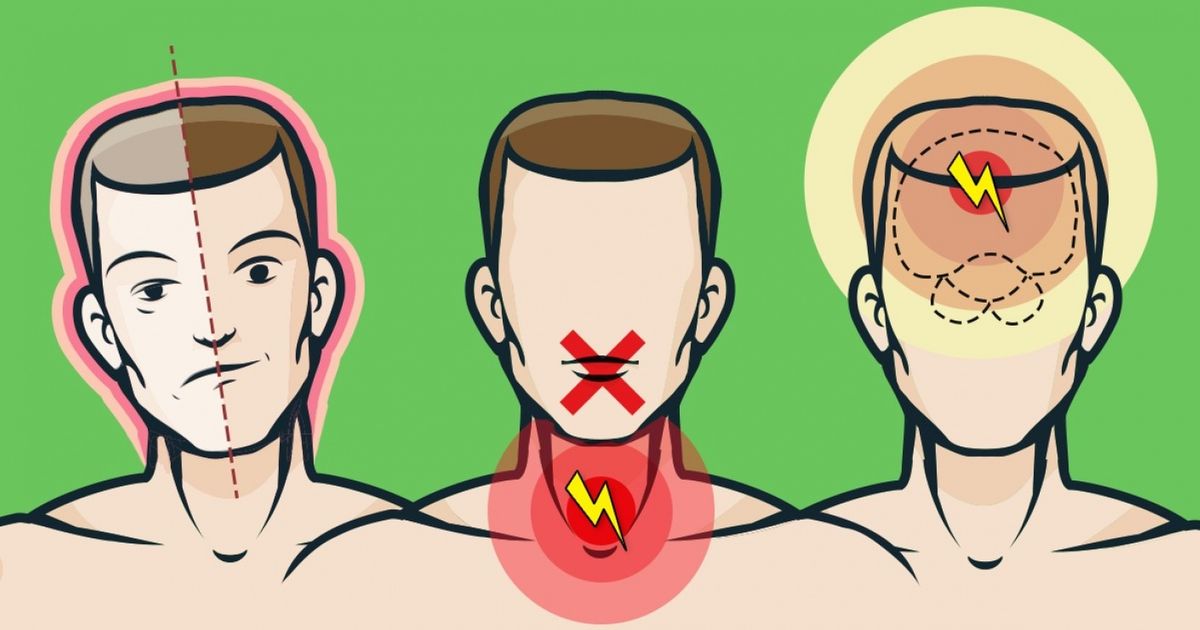 4 простых шага, чтобы сразу распознать инсульт 4 простых шага, чтобы сразу распознать инсульт