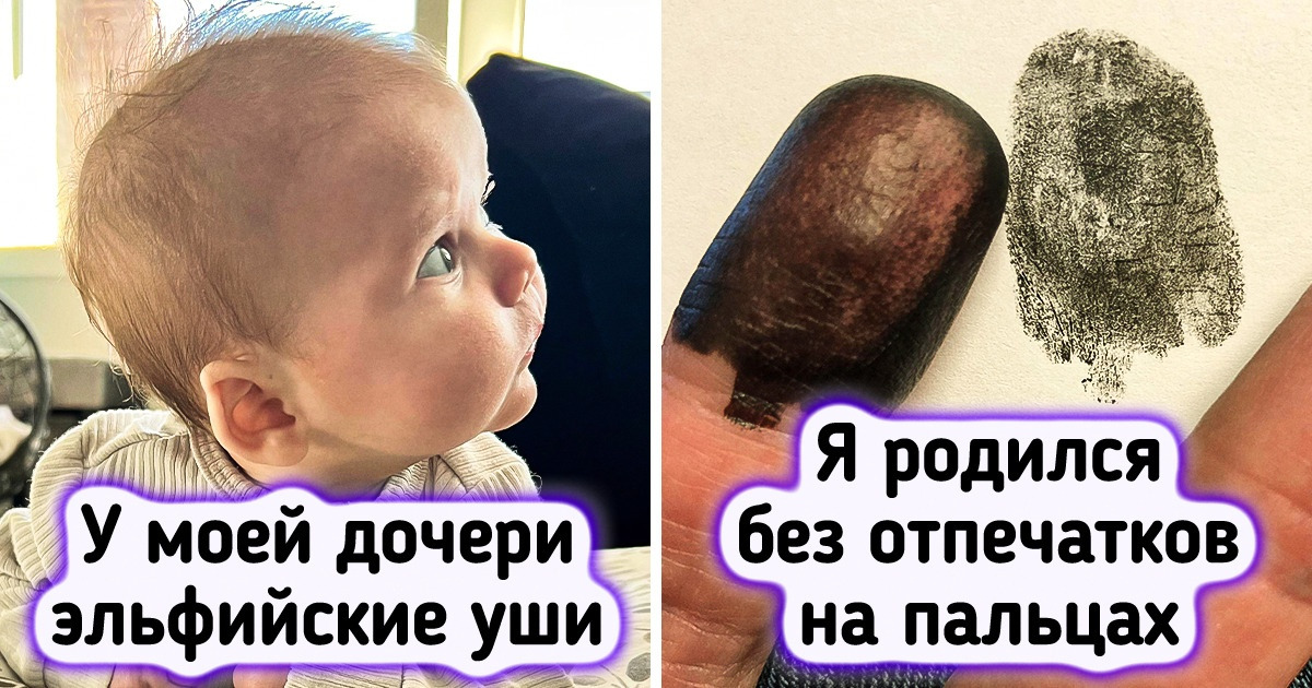 20+ людей с особенностями, которые кто-то посчитает генетической аномалией, а мы предпочитаем называть изюминкой 20+ людей с особенностями, которые кто-то посчитает генетической аномалией, а мы предпочитаем называть изюминкой