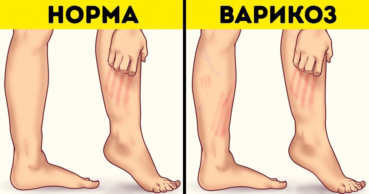 Dureri acute de picioare cu varice: simptome și prim ajutor - Varicoză noga noga