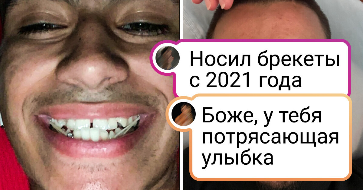 10+ человек, которые терпеливо носили брекеты и теперь гордо демонстрируют свои изменения 10+ человек, которые терпеливо носили брекеты и теперь гордо демонстрируют свои изменения