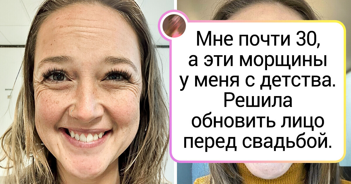 15+ женщин не постеснялись показать, как косметические процедуры изменили их внешность 15+ женщин не постеснялись показать, как косметические процедуры изменили их внешность