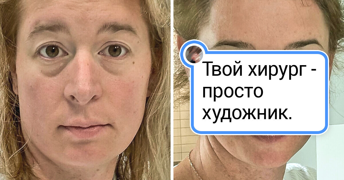 20+ женщин, которые решились на пластику и показали свое «до» и «после» 20+ женщин, которые решились на пластику и показали свое «до» и «после»