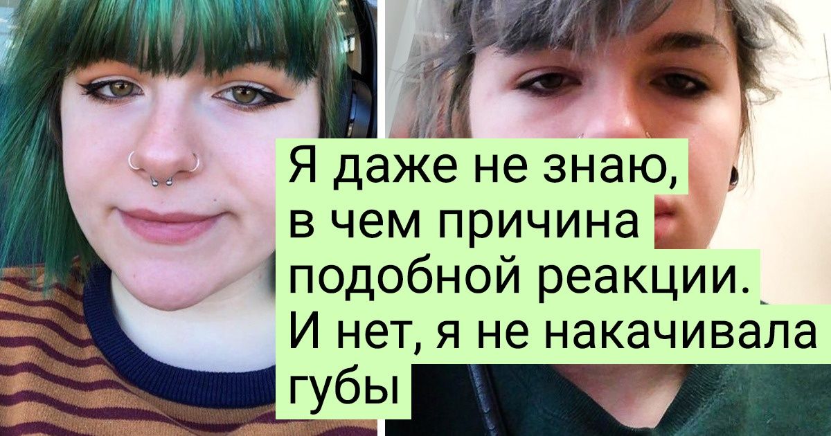20 человек рассказали, как им живется с редкими видами аллергии 20 человек рассказали, как им живется с редкими видами аллергии