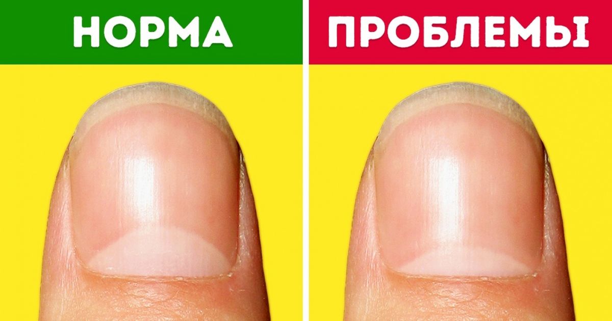 По ногтям можно определить проблемы со здоровьем фото