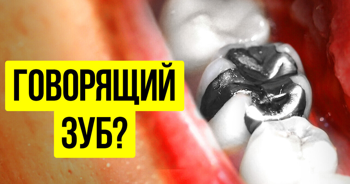 Эта женщина слышала радиосигналы через свой зуб Эта женщина слышала радиосигналы через свой зуб