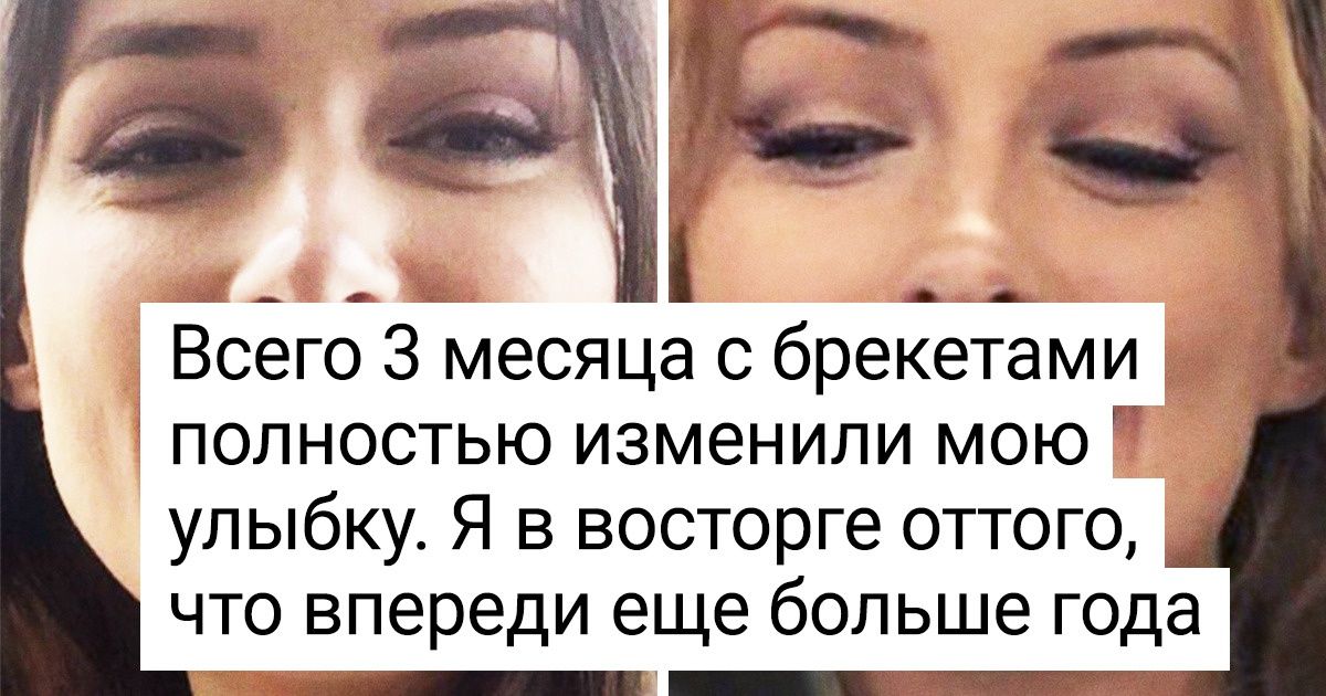 15+ человек, у которых после брекетов появилась новая привычка — широко улыбаться 15+ человек, у которых после брекетов появилась новая привычка — широко улыбаться