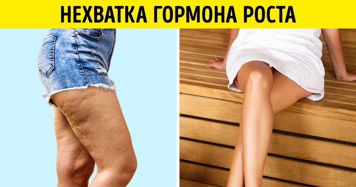 Дефицит гормона роста у детей