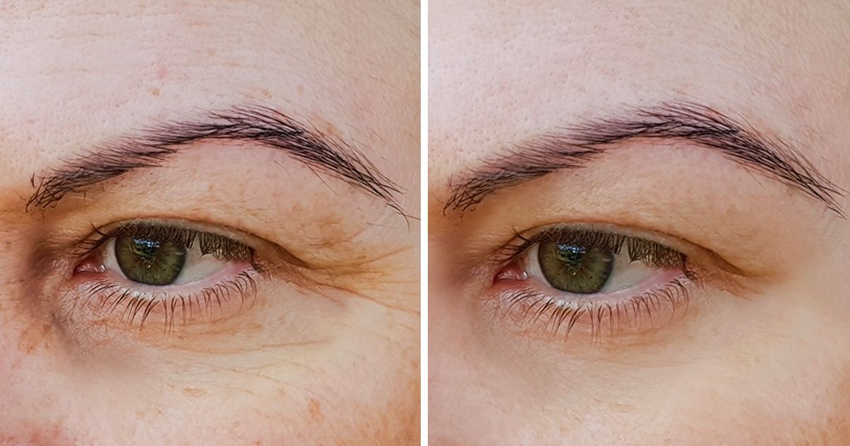 Уход за кожей вокруг глаз – секреты, эффективность и противопоказания