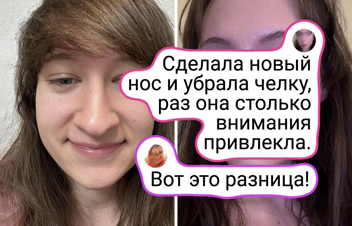 12 женщин показали, как пластика изменила их лица