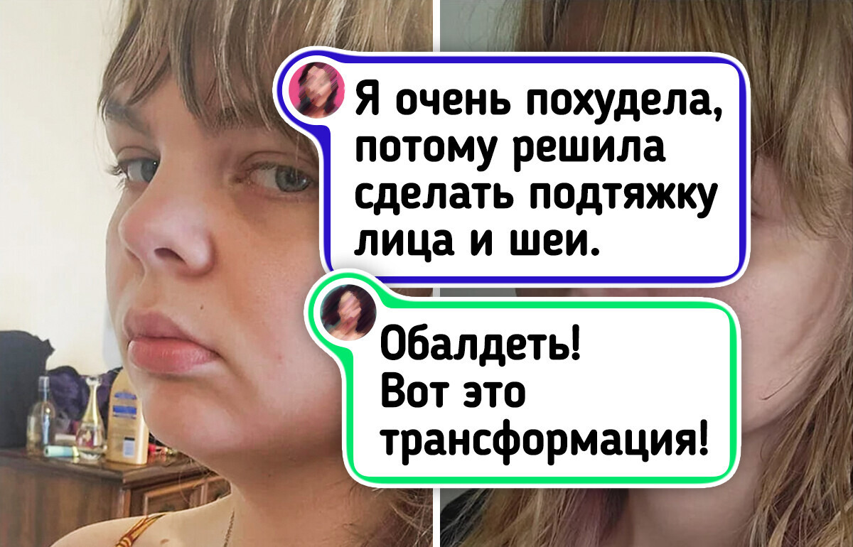 14 человек, которые решились на пластику и зажили по-новому 14 человек, которые решились на пластику и зажили по-новому