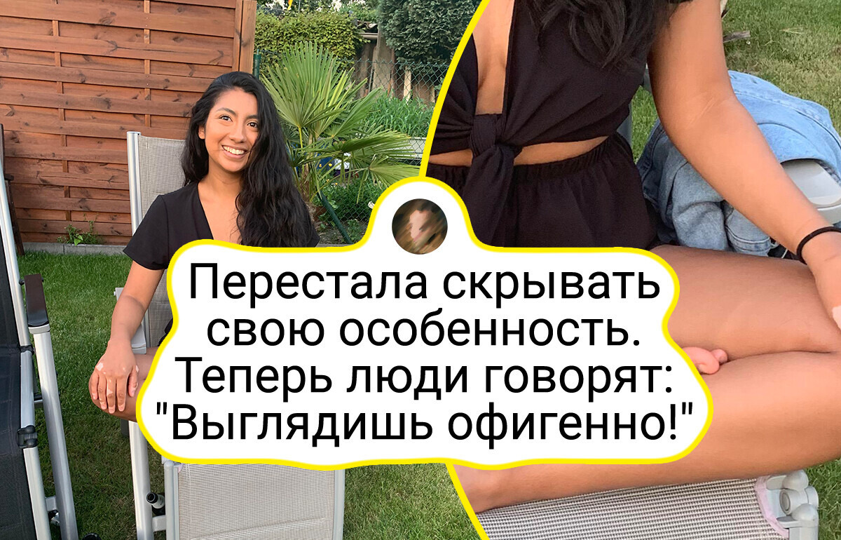 13 случаев, когда природа не поскупилась и подарила людям уникальные черты