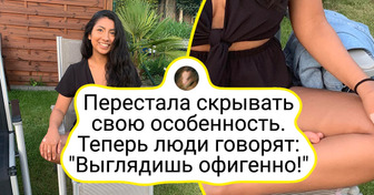 13 случаев, когда природа не поскупилась и подарила людям уникальные черты