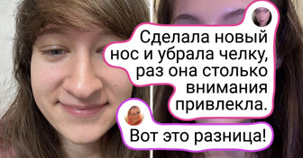 12 женщин показали, как пластика изменила их лица