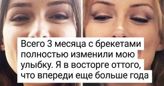 15+ человек, у которых после брекетов появилась новая привычка — широко улыбаться