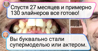 20+ человек, которые все же решились пойти к стоматологу, а теперь весь интернет нахваливает их улыбку