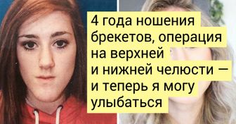 20+ человек, которые исправили только один недостаток внешности, и теперь их просто не узнать