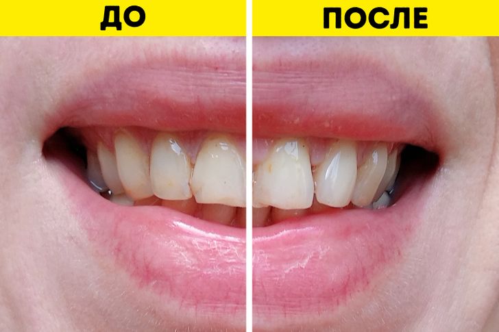 Как отбелить зубы в домашних условиях: 15 простых методов