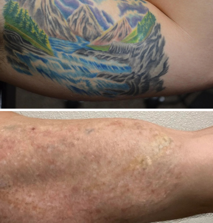 Удаление татуировки — как выглядит кожа после процедуры, о чем стоит знать