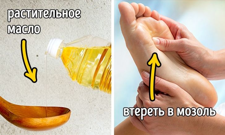 11 легких способов вылечить мозоль от неудобной обуви