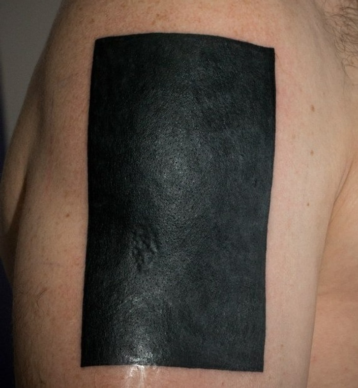 Видалення татуювання - як виглядає шкіра після процедури, про що варто знати