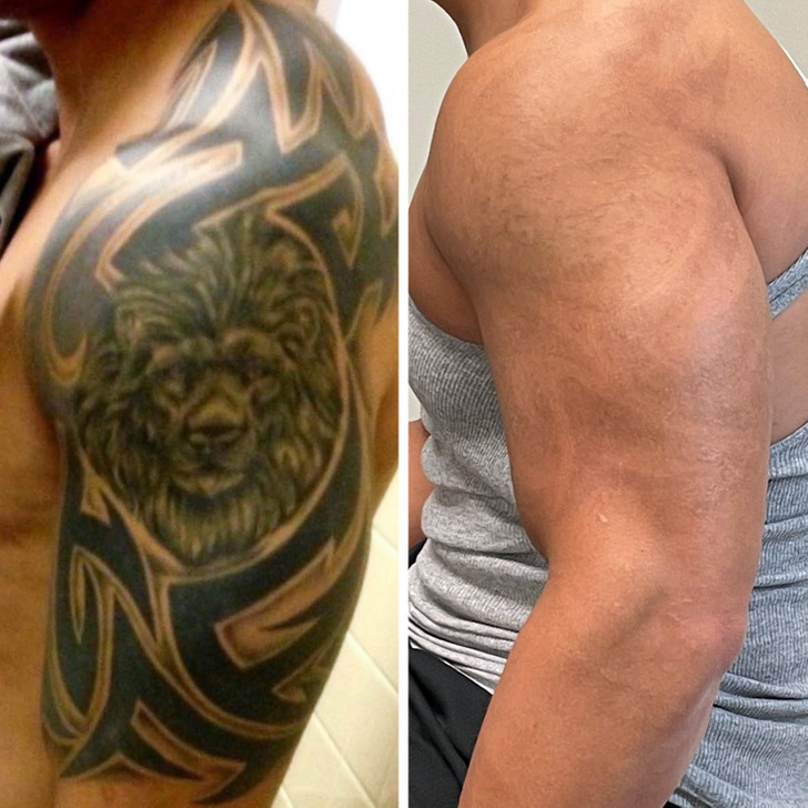Удаление татуировки — как выглядит кожа после процедуры, о чем стоит знать